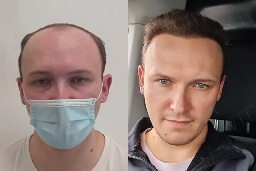 avant et après greffe de cheveux