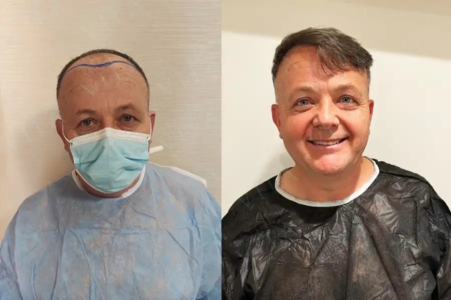 avant et après greffe de cheveux